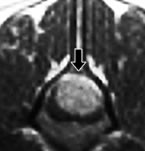 図3　MRIが診断に有効である脊髄疾患C