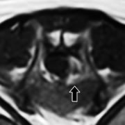 図4　MRIによる椎間板ヘルニアの予後の予測D